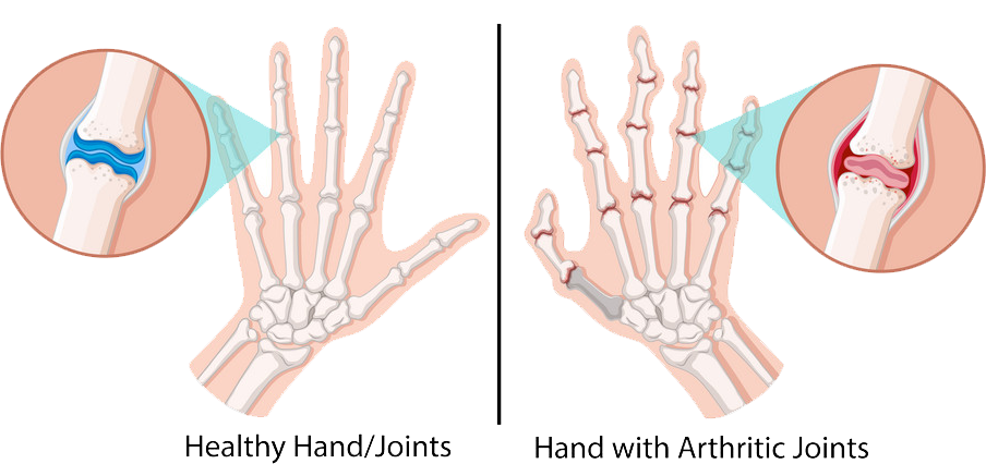 Arthritis Treatment