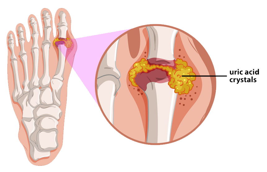 Gout Causes